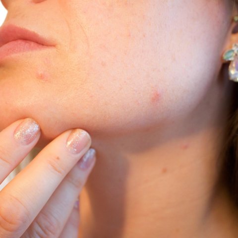 Zdjęcie: Trądzik a mikrobiom: dlaczego antybiotyki miejscowe to nie jedyne wyjście