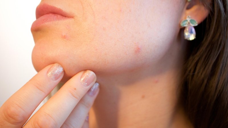 Zdjęcie: Trądzik a mikrobiom: dlaczego antybiotyki miejscowe to nie jedyne wyjście